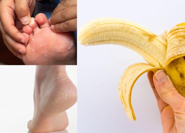 calcaie crapate talpi uscate cauze remedii naturiste