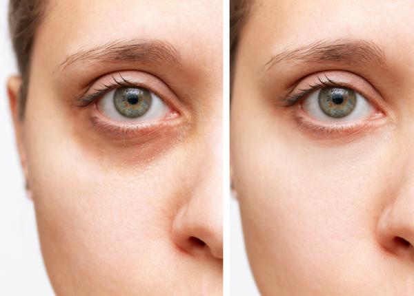 cum elimini cearcanele in doar zece minute