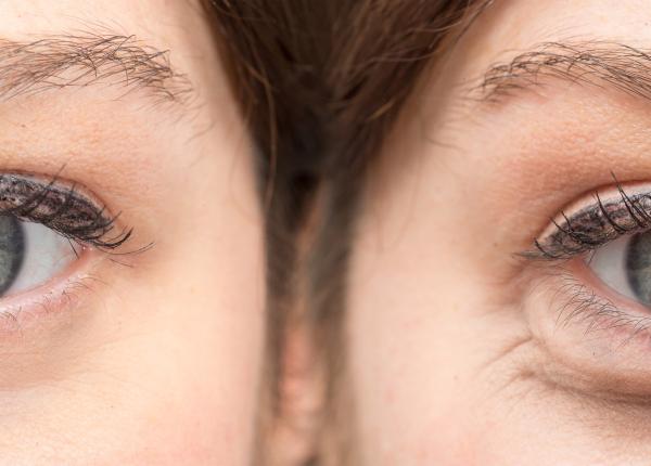 deficitul de vitamine si burnout ul cauze pentru aparitia cearcanelor cum poti scapa de ele