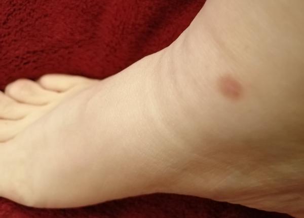 dermatofibromul cauze diagnostic si tratament femeile sunt mai predispuse