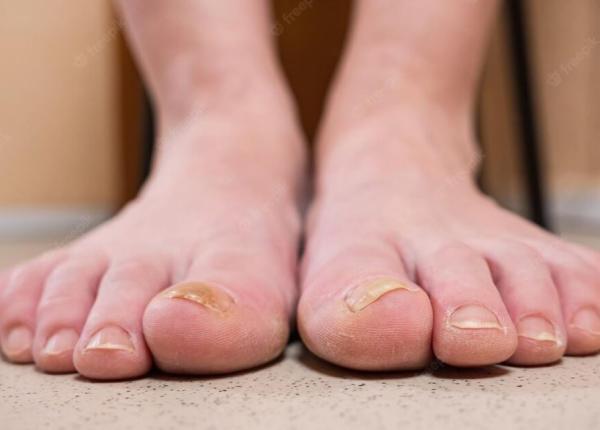 trateaza micoza unghiilor acasa