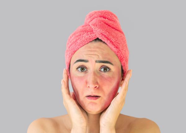 cuperoza cauze si tratament dermatolog stresul psiho emotional factor agravant