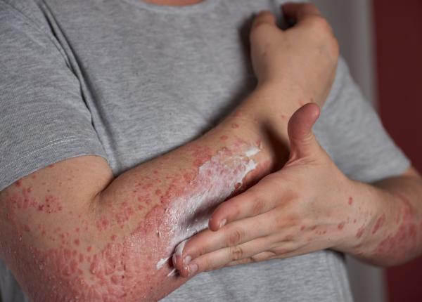 psoriazisul efect si asupra psihicului
