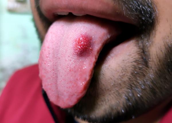 cancerul oral cresteri alarmante