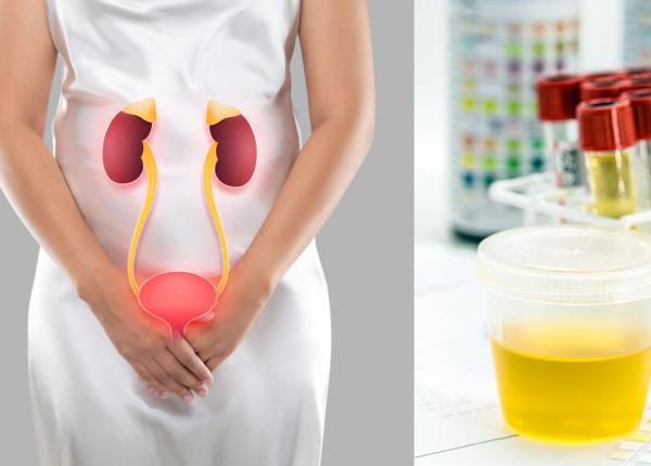 infectiile urinare frecvente in randul femeilor infectiile urinare frecvente in randul femeilor