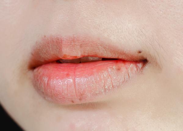 buzele crapate cauze si tratament