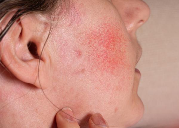 cancer de piele helicobacter pylori melanom dermatita rozacee