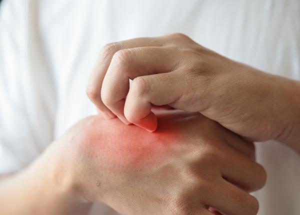 dermatita atopica mai vizibila cand este frig