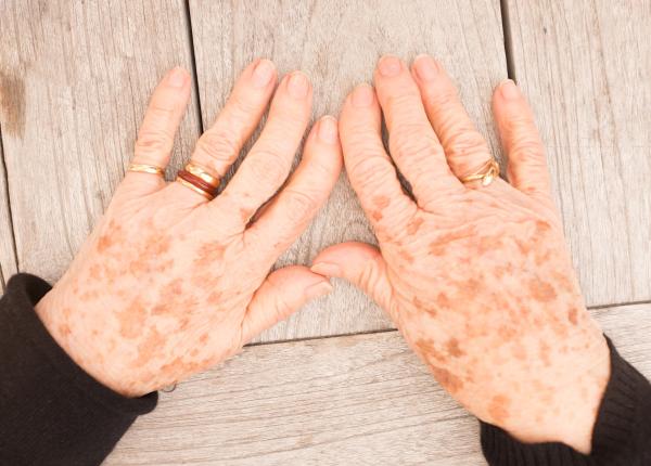 pielea si reactiile dupa tratamentele oncologice dermatolog