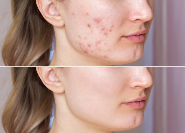 cum sa scapi de acnee si ce rutina trebuie folosita