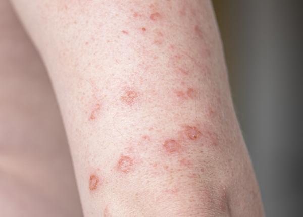 sindromul sweet afectiune a pielii cauze si tratament