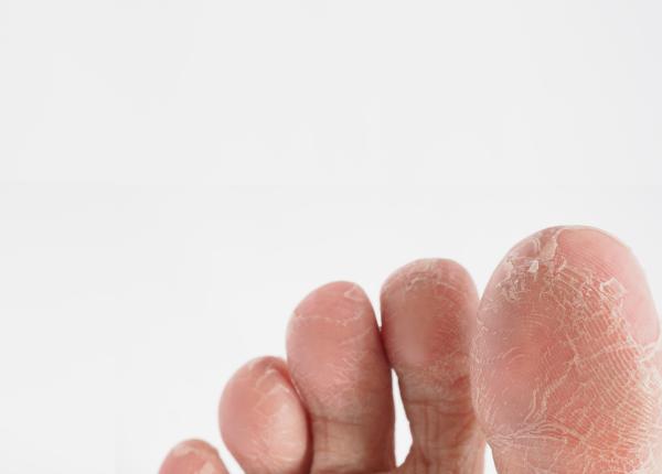 pielea exfoliata intre degetele de la picioare cauze