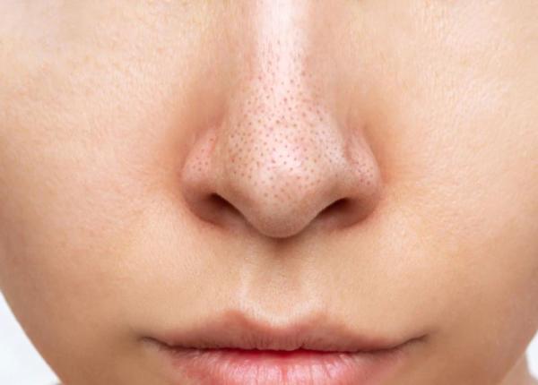 ai puncte negre pe fata uita de creme