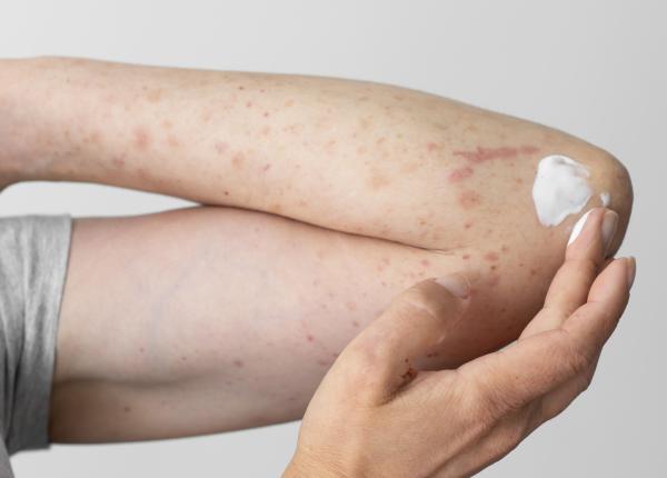 alergia la detergent cauze si simptome alergia la detergent cauze si simptome