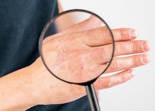 dermatita herpetiforma boala duhring cauze simptome si tratament badea