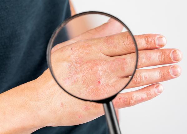 eczema asteatotica frecventa in sezonul rece