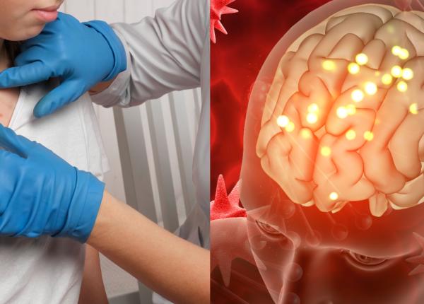 varicela factor de risc pentru accidentul vascular cerebral