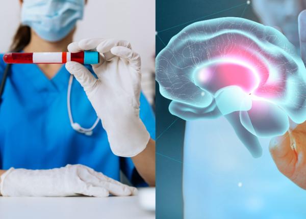 kit de diagnosticare a bolii alzheimer aprobat spre vanzare