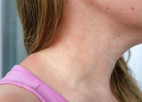 alergia la mancare cum stii ca ti a cazut rau mancarea