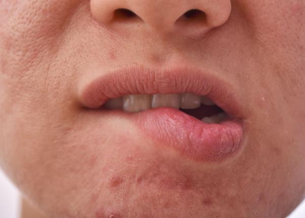 patru motive pentru care buzele tale sunt mereu crapate