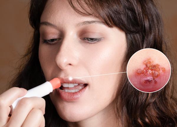 cum sa scapi de herpes in cateva ore 8 remedii de urmat acasa