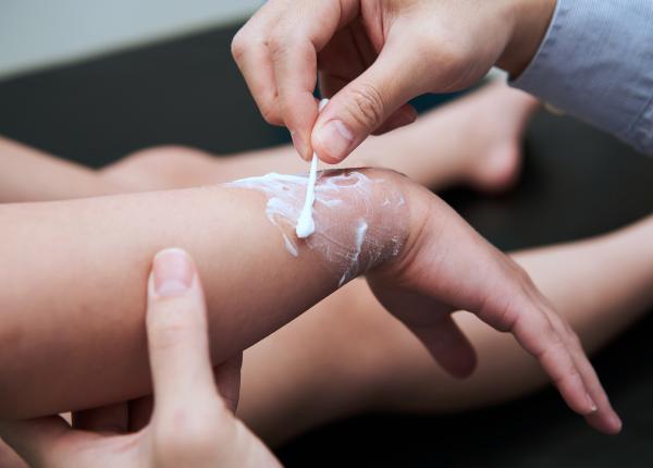 cum tratezi arsurile minore ce sa nu pui niciodata pe rana