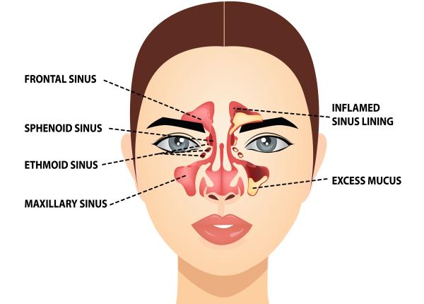 sinuzita cauze simptome tratament trebuie 10 14 zile ca sa tratezi cu adevarat inflamatia sinuzita cronica poate dura si cativa ani