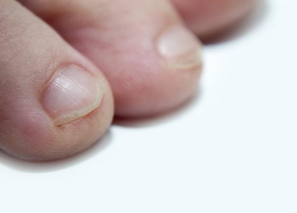 onicomicoza unghiile groase de la picioare cauze si tratament