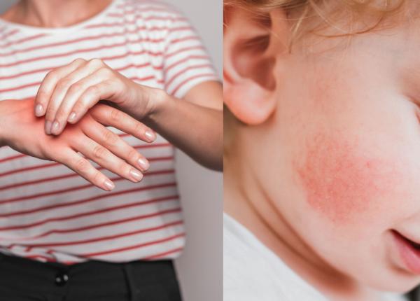 eritemul infectios cauze simptome diagnostic si tratament