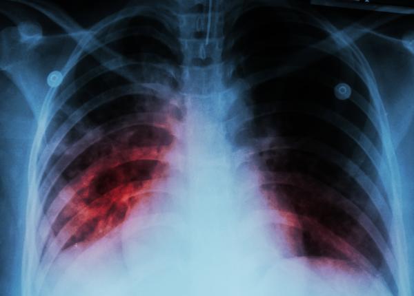 pneumonia interstitiala cauze simptome tratament tuse respiratie