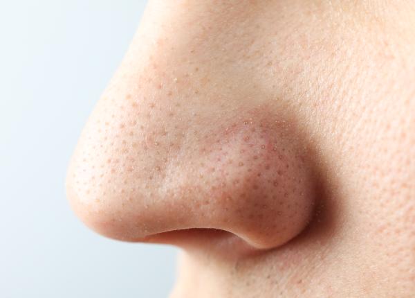 punctele negre comedoamele mituri desfiintate