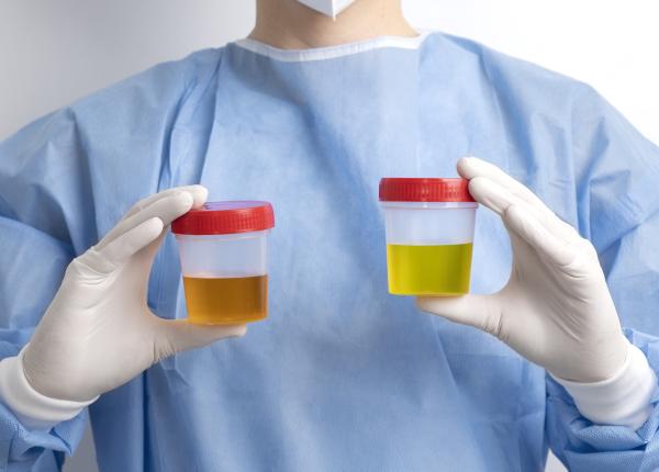 cancer renal primul semn hematurie sange urina dijmarescu infectie urinara cancer renal primul semn hematurie sange urina dijmarescu infectie urinara