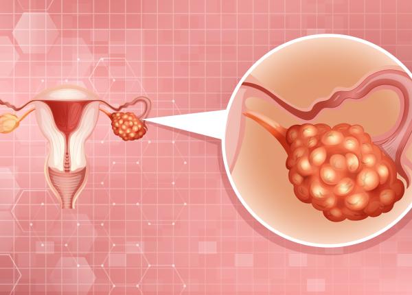 chist ovarian simptome tratament dijmarescu rmn chist malign belign inflamator