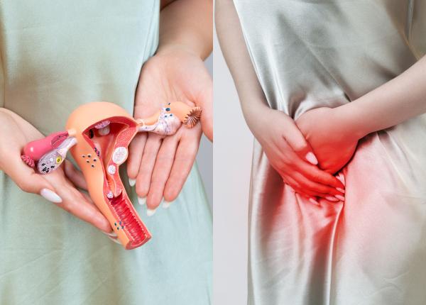 endometrioza simptome diagnostic rmn dijmarescu