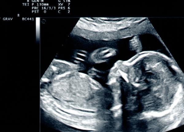 cele 3 ecografii importante in sarcina trimestrul 1 2 si 3 sexul bebelusului herghelegiu