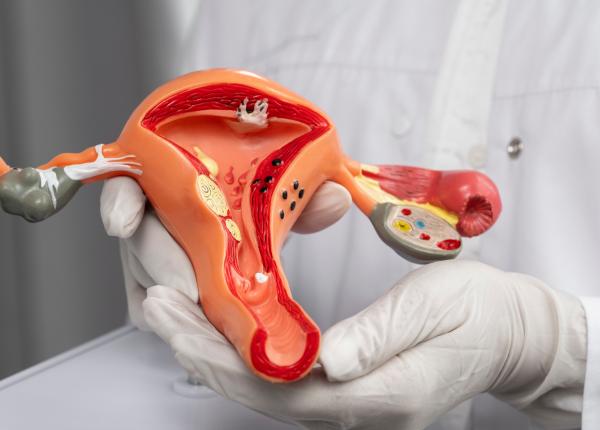 cancerul de col uterin cand se recomanda brahiterapia