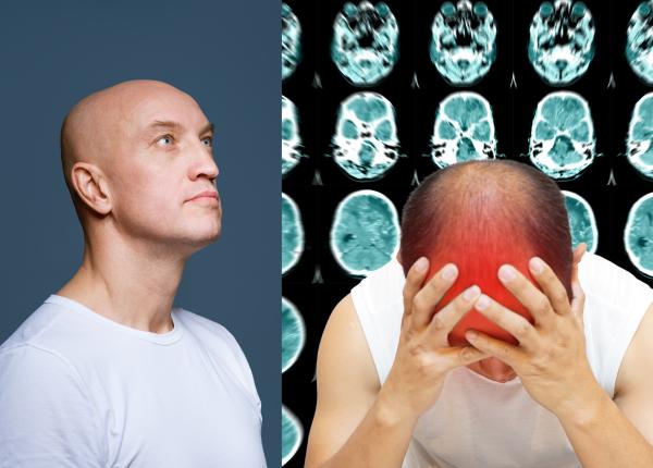 a aflat ca are cancer pe creier amorteala rmn biopsie scleroza multipla