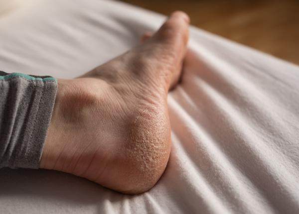 calusurile si bataturile cauze si tratament