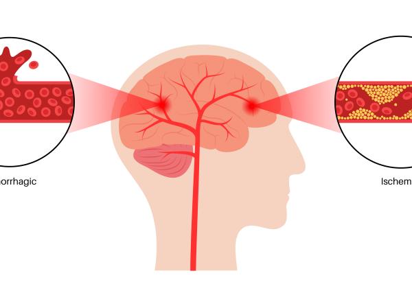 cum stii daca ai anevrism cerebral durerea de cap cefalee varsta rmn cum stii daca ai anevrism cerebral durerea de cap cefalee varsta rmn