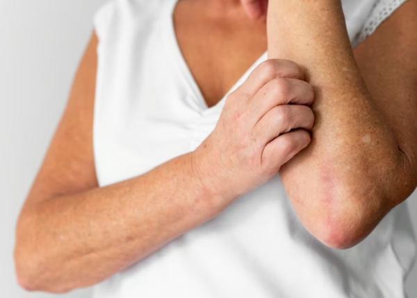 piele iritata din cauza nichelului