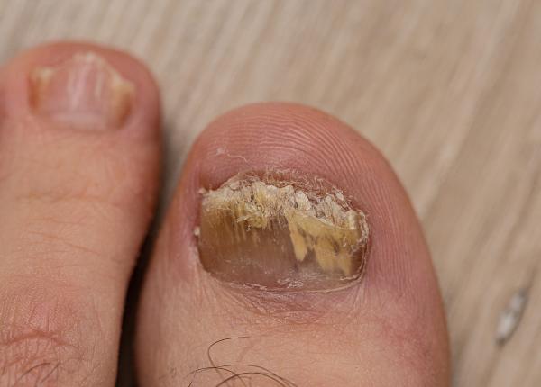ciuperca unghiei cauze si tratament