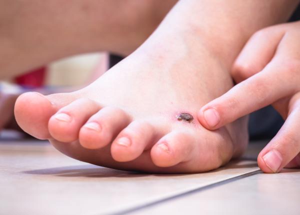 arteriopatia diabetica boala ce afecteaza jumatate dintre diabetici