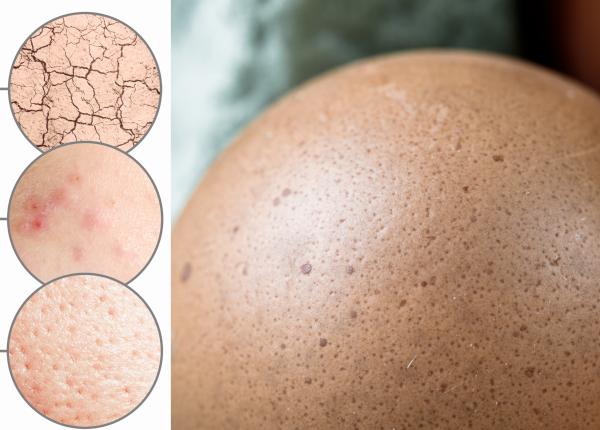 foliculita ce este cauze simptome viviana iordache firele de par incarnate