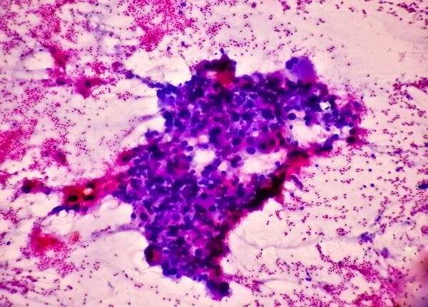 cancer femeie fumat tigari winston churchill eniko fejer