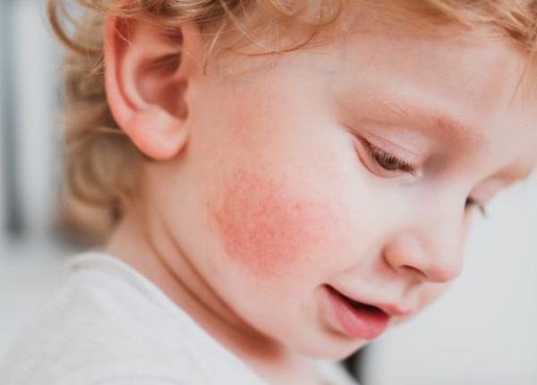 dermatita atopica boala complexa