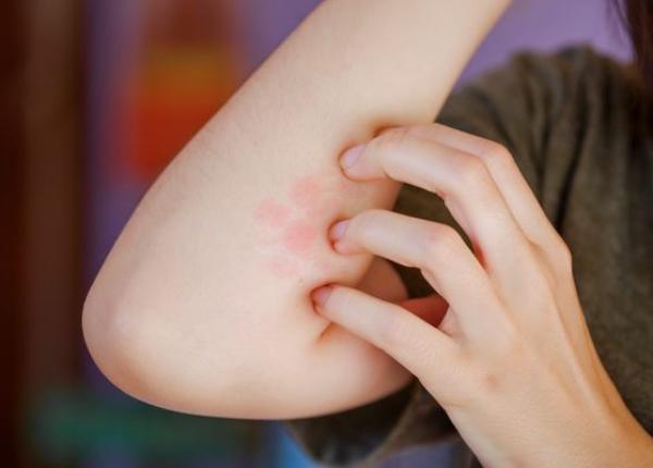 scarlatina cauze simptome si tratament transmitere dorobat