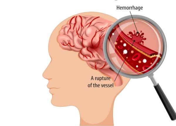 accidentul vascular cerebral ischemic simptome tratament trombectomia toader accidentul vascular cerebral ischemic simptome tratament trombectomia toader