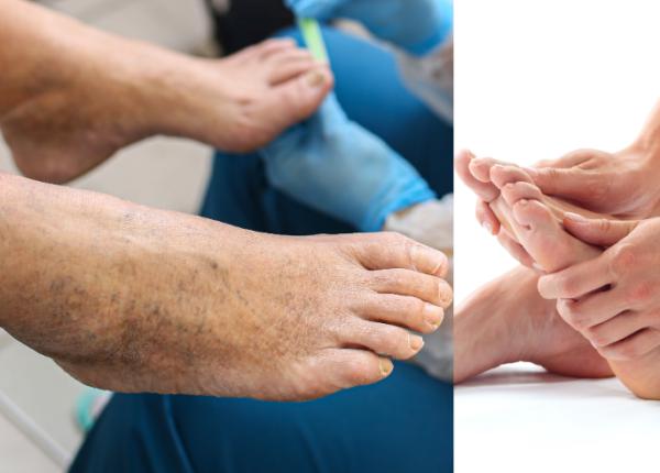 boala arteriala periferica durere de picior picioare reci degete negre sanador