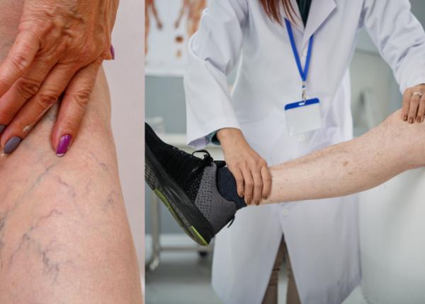 varice toate metodele de tratament si recuperare ce trebuie sa stie orice pacient care sufera de varice toni feodor varice toate metodele de tratament si recuperare ce trebuie sa stie orice pacient care sufera de varice toni feodor