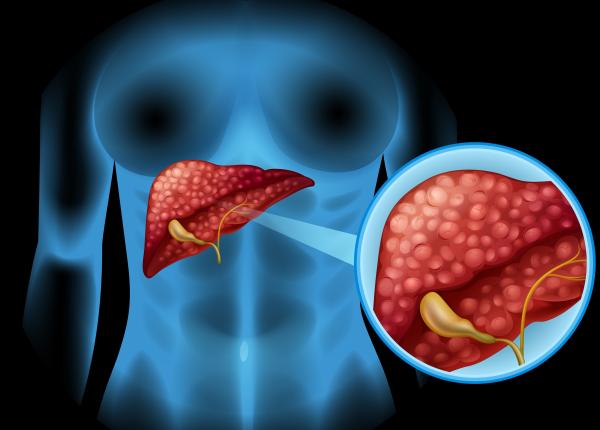 cum stii daca ai o tumoare hepatica bogdan martian